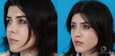 35-44 year old woman treated with Revision Rhinoplasty - This patient had a very prominent assymmetry in nostrils and crooked nose. Her left nostril was completely closed. All these imperfections were fixed by revision rhinoplasty.