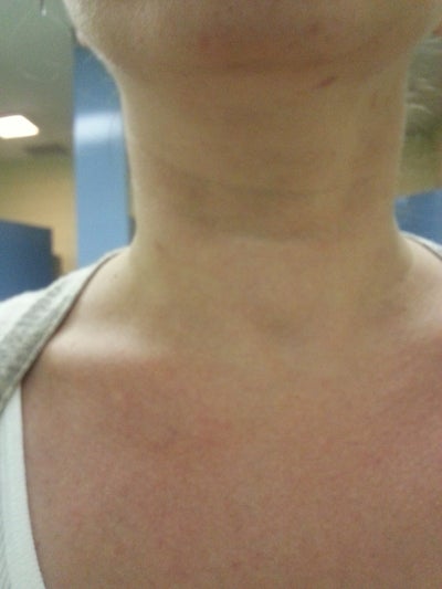 wrinkles thyroid facial Deep