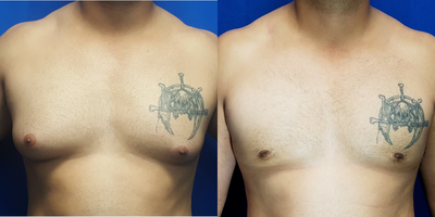35-44 year old man treated with Gynecomastia Surgery - 39 year old male who complained of large breasts with the right being larger than the left. He had a male breast reduction for his gynecomastia. The incision was through the inferior areola. His postoperative photo is 7 weeks after surgery. His height is 5 feet 9 inches and weight is 190 lbs. The right side had 138 grams removed and the left side had 94 grams removed.