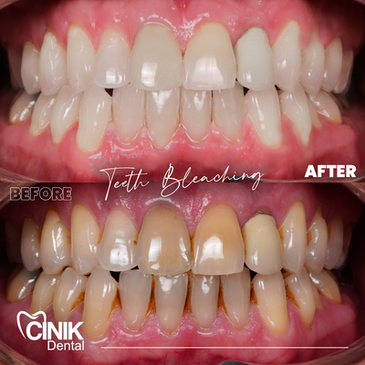 25-34 year old man treated with Teeth Whitening - Teeth Whitening