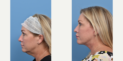 45-54 year old woman treated with Facelift - 54 year old seeking to refresh her appearance with a facelift. Her lower face and neck are much improved.