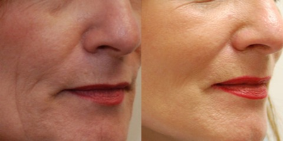 Woman treated with Laser Resurfacing - Facial Resurfacing