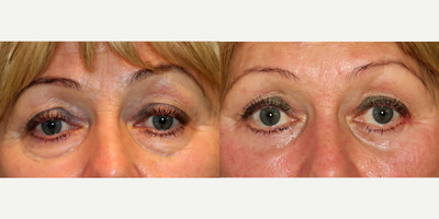 45-54 year old woman treated with Eyelid Surgery - lower blepharoplasty