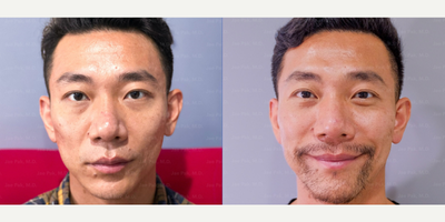 Beard Transplant - Man treated with Beard Transplant