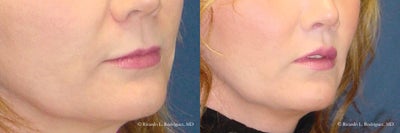 Woman treated with Lip Lift - Woman treated with Lip Lift usingadvanta lip implants along with upper lip lift.