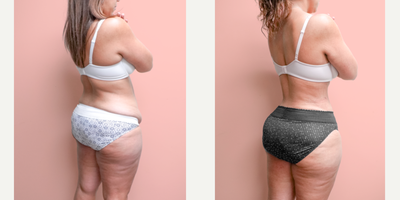 35-44 year old woman treated with Liposuction, Tummy Tuck - This patient lost significant weight through diet and exercise but this resulted in sagging skin and an underwhelming result after all her efforts. She is shown here 2 months post-op from 360 Lipo suction and abdominoplasty. She was able to achieve a snatched shape and amazing curves which complimented her flat abdomen.