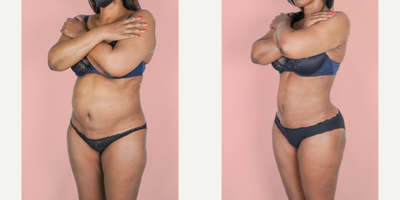 55-64 year old woman treated with Tumescent Vaser Liposuction Revision - This patient had prior liposuction by another surgeon but this left her with residual fat and an unsatisfying result. She is shown here 3 months post-op from 360 Lipo suction. She was finally able to achieve a cinched waistline and smooth contour.