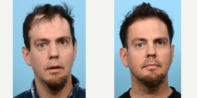 35-44 year old man treated with FUE Hair Transplant, Hair Transplant, Hair Loss Treatment, PRP for Hair Loss - This patient had hair loss and scarring as a result of an auto accident and was looking to cover the scar and additionally strengthen his hairline, and add overall density. Dr. Wise performed an FUE hair transplant, placing 3,050 grafts in zones 1, 2, and 4 to rebuild hair growth that would blend in to conceal his scar. One year post-op the patient is very thrilled with how his results look!