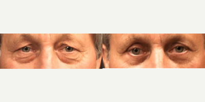 Man treated with Eyelid Surgery - Man treated with Eyelid Surgery