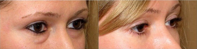 Woman treated with Eyelid Surgery - She underwent transconjunctival blepharoplasty