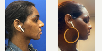 Patient treated with African American Rhinoplasty - Septorhinoplasty (Closed) with Cartilage Grafts - 25 to 34 year-old female patient is 7 months post-op from Facial Feminization surgery. Her procedures included: Forehead Lift, Hairline Lowering, Orbital Bony Contouring; Septorhinoplasty (Closed) with Cartilage Grafts and Weirs; Chin Reduction and Contour; Soft Tissue to Nasolabial Folds; Subnasal Lip Lift; Thyroid Cartilage Shave and 2 ccs Juvederm Voluma.