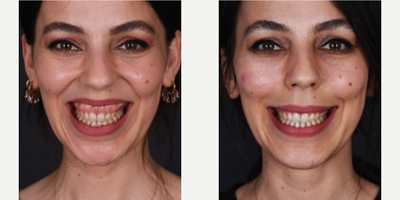 18-24 year old woman treated with Botox for Gummy Smile - By Assoc.Prof.Gurkan KAYABASOGLU
