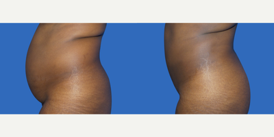 35-44 year old woman treated with Liposuction - This 36 year old female presented to Dr. Greenberg wishing for a more shapely figure, specifically more fullness/projection of her buttocks and better overall body contour of the abdomen, flanks and thighs. This patient wished for a Brazilian Butt Lift (BBL) and requested liposuction of her abdomen, flanks and inner and outer thighs to provide enough fat for harvest to achieve the fullness/volume that she desired. Once her candidacy was determined, Dr. Greenberg performed liposuction of her abdomen, flanks, and inner and outer thighs with a BBL to achieve the overall body contour that she ultimately wished for. At 3 months post-op 