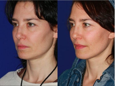 35-44 year old woman treated with Mini Facelift - This young woman was concerned with early aging changes including jowls and some loose skin under the chin. The mini facelift procedure gave her a youthful, more refreshed appearance accentuating her natural beauty and boosting confidence