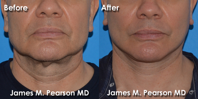 55-64 year old man treated with Facelift - 55-64 year old man treated with Facelift and Neck Lift