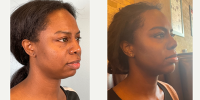 35-44 year old woman treated with Buccal Fat Removal, Jawline Sculpting, Chin Implant, Facial Fat Transfer - The CHEEKAGO!!