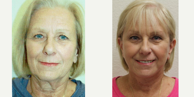 Facelift and Browlift - This 66 year old, very kind, female, underwent a facelift with temporal brow lift.