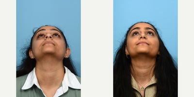 25-34 year old woman treated with Septoplasty - This 28-year-old patient felt very unhappy with the size and shape of her nose, as she had been self-conscious about it her entire life. The doctor performed a rhinoplasty to deemphasize the bump and make the tip smaller. 7 weeks post-op,.