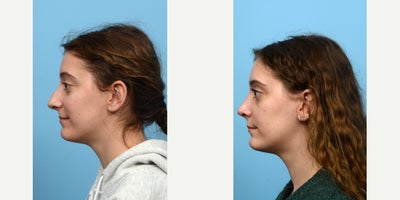 18-24 year old woman treated with Septoplasty - Looking to correct some breathing problems along with improving her nose shape, this 23-year-old patient turned to Dr. Wise for rhino-and septoplasty. Six weeks after the surgery, the patient loves her new nose and ability to breathe easy.