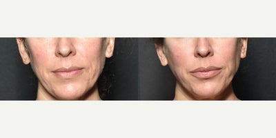 35-44 year old woman treated with Secret RF, Microneedling RF - This patient had SecretRF, microneedling with radiofrequency, and is 6-months out from her treatments