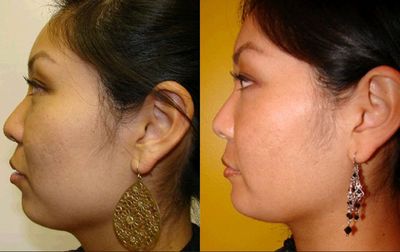 Chin Implant - Female shown before and after chin implant and liposuction of neck.