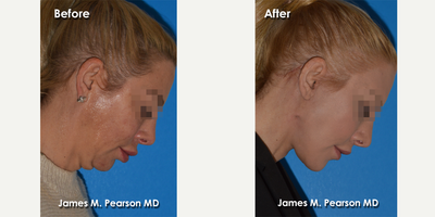 55-64 year old woman treated with Facelift, Deep Plane Facelift, Neck Lift - 55-64 year old woman treated with Facelift