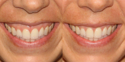 25-34 year old woman treated with Botox for gummy smile - Dr. Groff treated this patient with Botox to help minimize the appearance of her gummy smile.