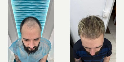 25-34 year old man treated with DHI Hair Transplant - A male patient aged 2534 presented with progressive frontal hairline recession and reduced density in the frontal zone.The treatment goal was to restore a natural-looking hairline and improve overall density while preserving facial proportions and age-appropriate aesthetics.A DHI hair transplant was performed with careful graft placement to ensure natural direction, angle, and density. The procedure was planned individually based on scalp condition, donor area quality, and long-term hair loss progression.Follow-up photos were taken 6 months after the procedure, showing visible improvement in density and a natural frontal hairline. Further maturation of results is expected over the following months.