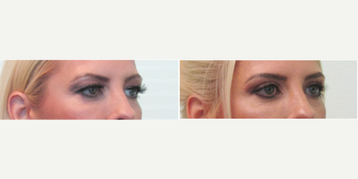 45-54 year old woman treated with Upper Eyelid Surgery (Blepharoplasty) - This woman presented with the complaint of excess skin and heaviness over her eyelids. She had used botox for many years with decreasing results and wanted a more permanent result to open her eyes naturally. Her pre-procedure examination revealed sufficiently elevated eyebrows with a significant excess of eyelid hooding (from thin skin overhang). She stated that her makeup application was becoming more difficult, and that her eyes literally felt heavy to her especially at the end of each day. We discussed the option of performing an upper blepharoplasty under local anesthesia in our office. With mild oral sedation with valium, the procedure was performed in our Center in under one hour's time. We were able to remove the vast majority of the excess skin while still preserving the natural shape of her eye and eyebrow. The stitches were removed on the 5th day after procedure and she could resume make up application a few days later.