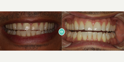 Man treated with Invisalign - Man treated with Invisalign