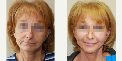 Liquid Facelift - Fat Transfer - Patient had Fat Transfer to temples, periorbital area, cheeks, perioral area