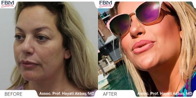 45-54 year old woman treated with Deep Plane Facelift, Facelift, Facial Fat Transfer, Neck Lift, Rhinoplasty, Eyelid Surgery - 45-54 year old woman treated with Deep Plane Facelift, Facelift, Facial Fat Transfer, Neck Lift, Rhinoplasty, Eyelid Surgery