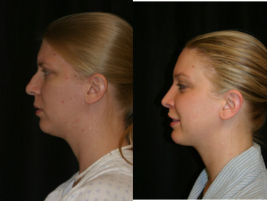 Chin Implant - Chin Implant