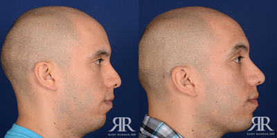 Rhinoplasty - Rhinoplasty