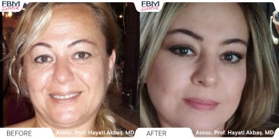 45-54 year old woman treated with Deep Plane Facelift, Neck Lift, Facelift, Lip Lift, Eyelid Surgery, Facial Fat Transfer - 45-54 year old woman treated with Deep Plane Facelift, Neck Lift, Facelift, Lip Lift, Eyelid Surgery, Facial Fat Transfer