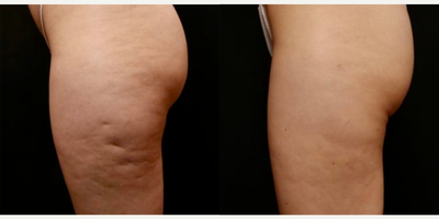 25-34 year old woman treated with Aveli - 29y/o with lateral thigh dimples that prevented her from feeling comfortable in a bathing suit since she was 13! One treatment with Aveli reduced the cellulite dimples to the point where she is happy to show her legs in swim wear