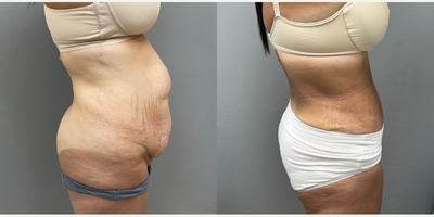 Woman treated with Tummy Tuck - Tummy Tuck