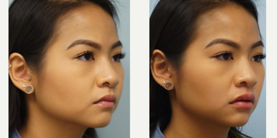 25-34 year old woman treated with Lip Augmentation - This attractive young female desires fuller lips albeit she already has full lips. Hyaluronic acid filler is used to outline the vermillion border of the upper and lower lips, the border between the red and white part of the lip.