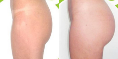 18-24 year old woman treated with Butt Implants - 18-24 year old woman treated with Butt Implants