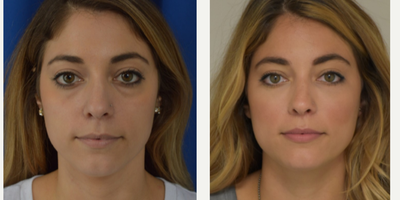 25-34 year old woman treated with Injectable Fillers - Natural results using Juvederm Voluma and Juvederm Ultra for treatment of cheeks and under eye area