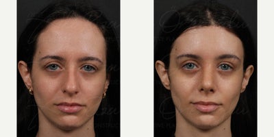 18-24 year old woman treated with Forehead Reduction, Rhinoplasty - A young female patient underwent forehead reduction. The images show her natural-looking results at 7 days postoperatively, with improved facial balance and rejuvenation.