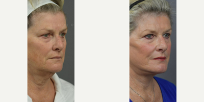 Woman treated with Deep Plane Facelift, Neck Lift, Laser Resurfacing - DEEP PLANE FACE & NECK LIFT with ACTIVE FX LASER RESURFACING. Dr. James Marotta see this patient back in office for her 6 month + post op visit. Check out that neck line and glowing skin! Beautiful, natural results worth sharing.