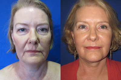 50-59 year old woman treated with Facial Fat Transfer - 50-59 year old woman treated with Facial Fat Transfer