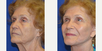 65-74 year old woman treated with Laser Treatment - Woman treated with Laser Treatment