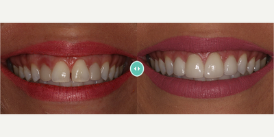 Woman treated with Porcelain Veneers - Woman treated with Porcelain Veneers
