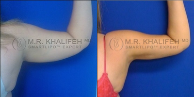 Woman treated with Vaser Liposuction - Woman treated with Vaser Liposuction