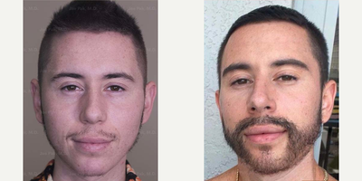 Beard Transplant - Man treated with Beard Transplant