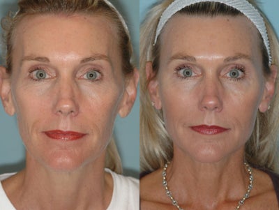 Lipografting Fat Transfer -
Before and After full face Lipografting fat transfer