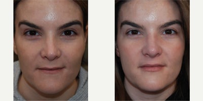 Non-surgical Rhinoplasty Before & After: Single Treatment Corrects Retracted Nostrils & Pointy Nasal Tip - Our lovely 32-year-old patient presented to our office with dissatisfaction with the appearance of her nose, 5 years following rhinoplasty surgery performed elsewhere. Her concern was that she saw a sharp edge of bone along her left nasal sidewall, and she did not like the appearance of her retracted nostrils. Utilizing topical anesthetic, microdroplet Silikon-1000 was injected to her left nasal sidewall, both nostril margins, and around her overly pointy nasal tip appearance. Or after photos were taken 2 weeks after her treatment, and she does not appear to need a second treatment as most people do. We are grateful that she has allowed us to post her photos, since a permanent non-surgical nose job treatment may be a welcome alternative to surgery for many people who are appropriate candidates, without the expense, uncertainty, and downtime associated with revision rhinoplasty surgery.