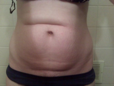 tummy tuck belly button scaabbed over